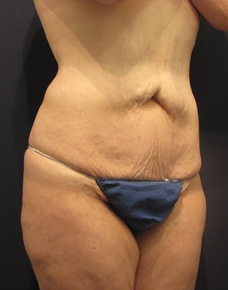 Massive Weight Loss Before & After Gallery - Patient 174163273 - Image 3