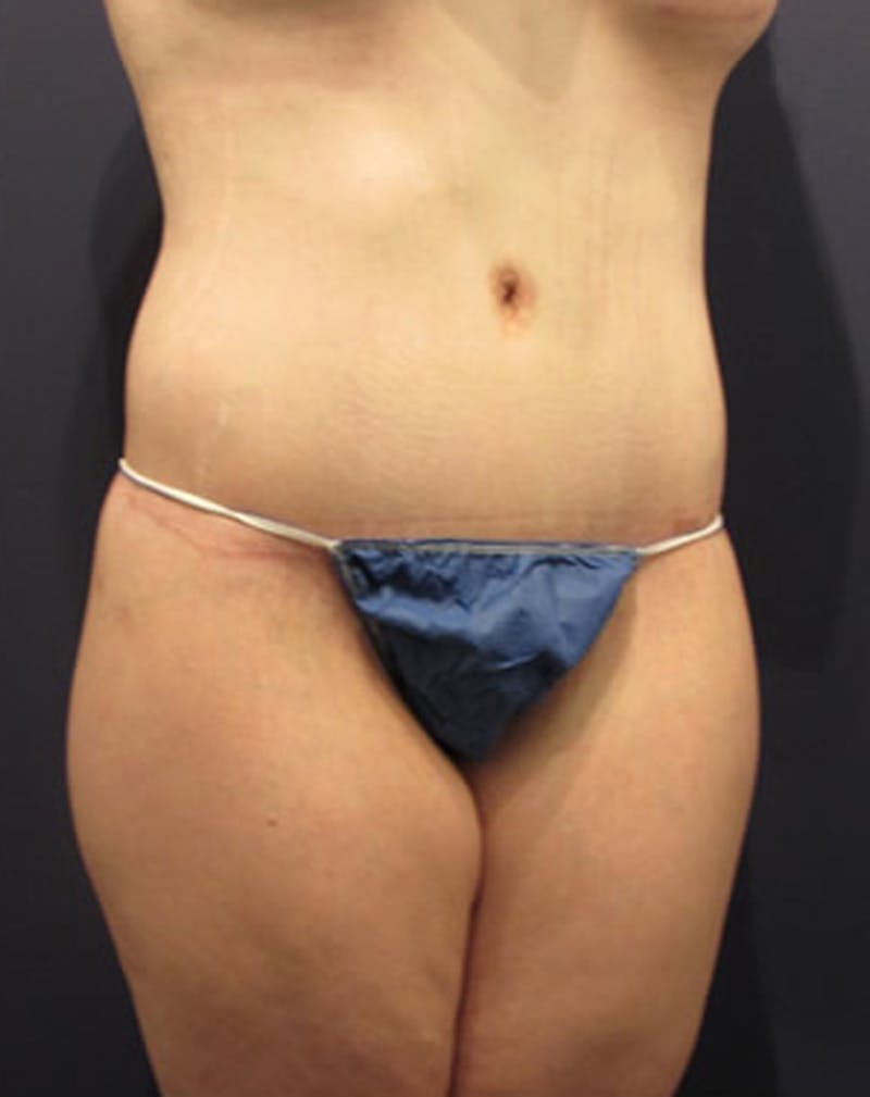 Massive Weight Loss Before & After Gallery - Patient 174163273 - Image 4