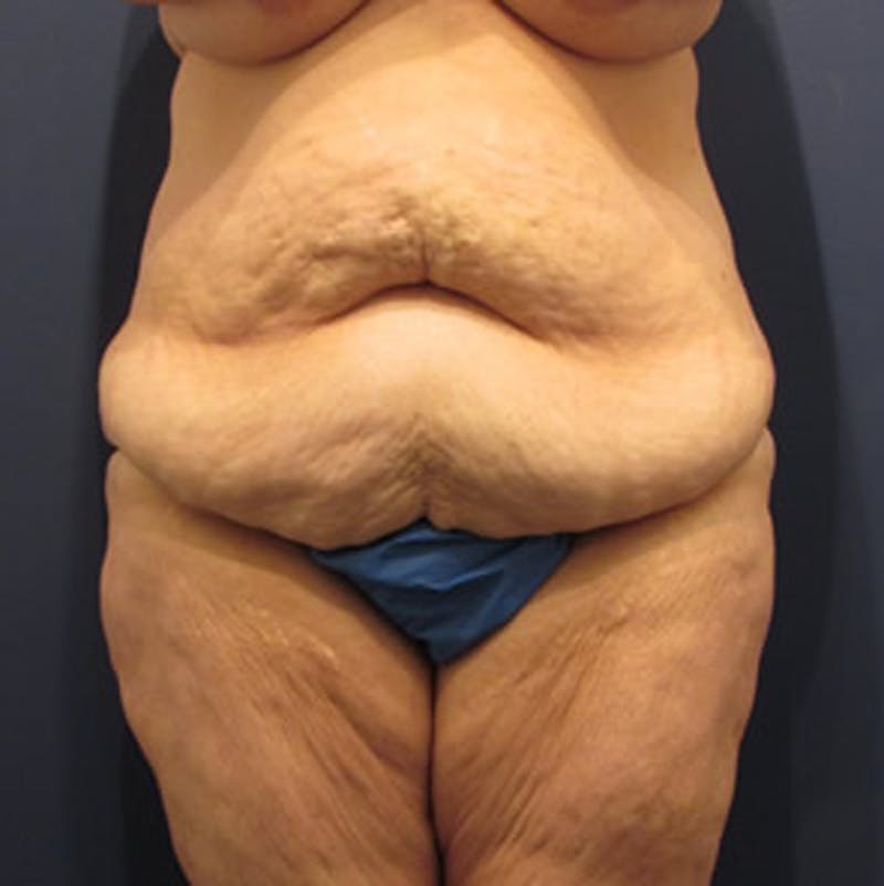 Massive Weight Loss Before & After Gallery - Patient 174163282 - Image 1
