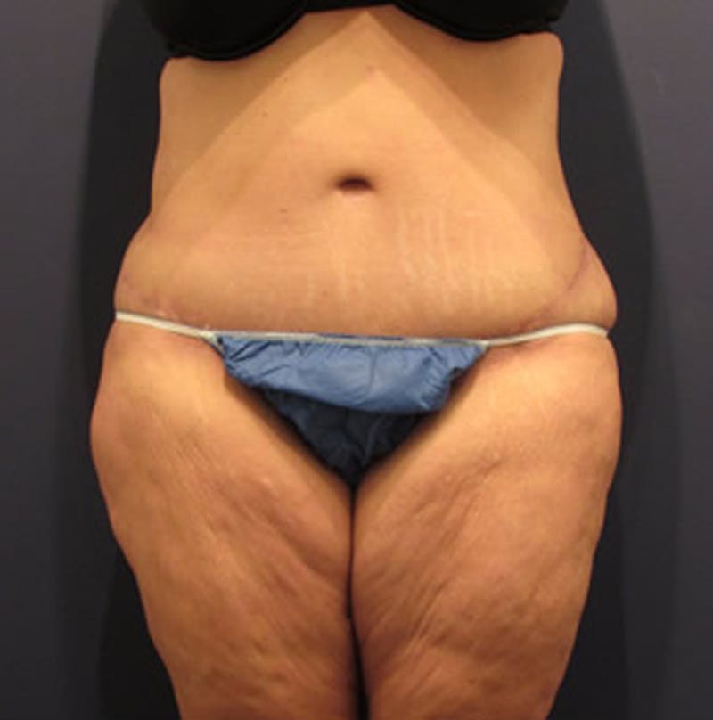 Massive Weight Loss Before & After Gallery - Patient 174163282 - Image 2