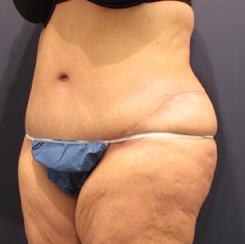 Massive Weight Loss Before & After Gallery - Patient 174163282 - Image 4