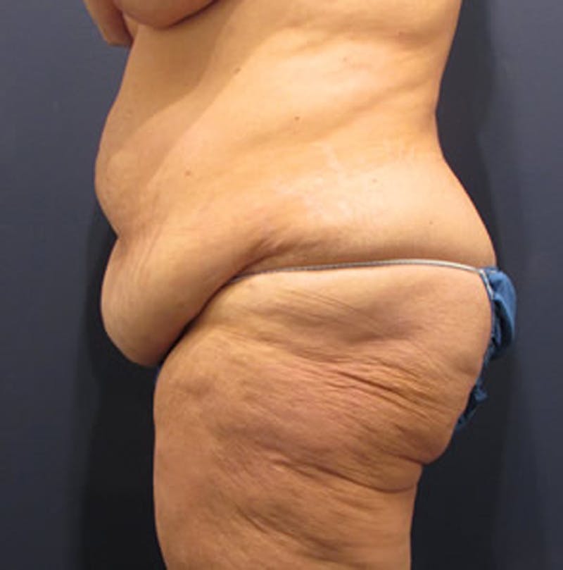 Massive Weight Loss Before & After Gallery - Patient 174163282 - Image 5
