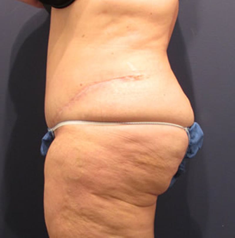 Massive Weight Loss Before & After Gallery - Patient 174163282 - Image 6