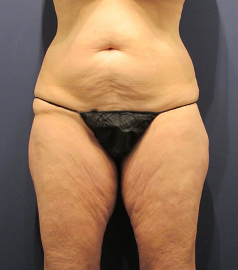 Massive Weight Loss Before & After Gallery - Patient 174163292 - Image 1