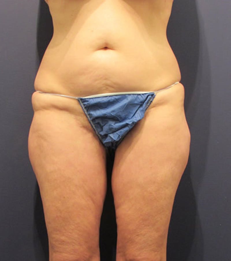 Massive Weight Loss Before & After Gallery - Patient 174163292 - Image 2