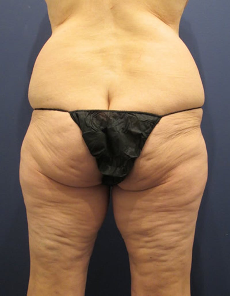 Massive Weight Loss Before & After Gallery - Patient 174163292 - Image 3