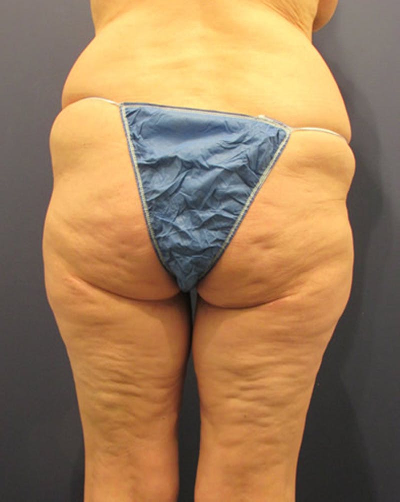 Massive Weight Loss Before & After Gallery - Patient 174163292 - Image 4