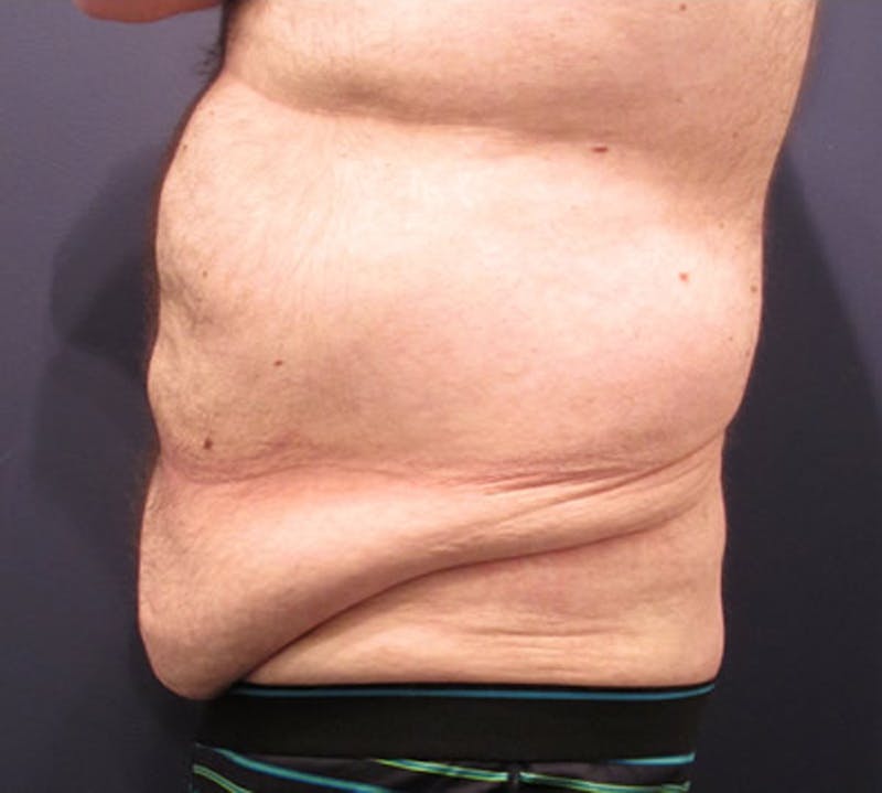 Massive Weight Loss Before & After Gallery - Patient 174163299 - Image 5