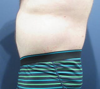 Massive Weight Loss Before & After Gallery - Patient 174163299 - Image 6