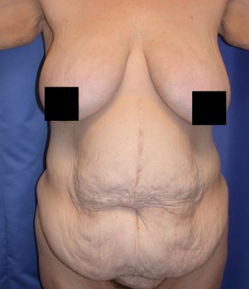 Massive Weight Loss Before & After Gallery - Patient 174163314 - Image 1