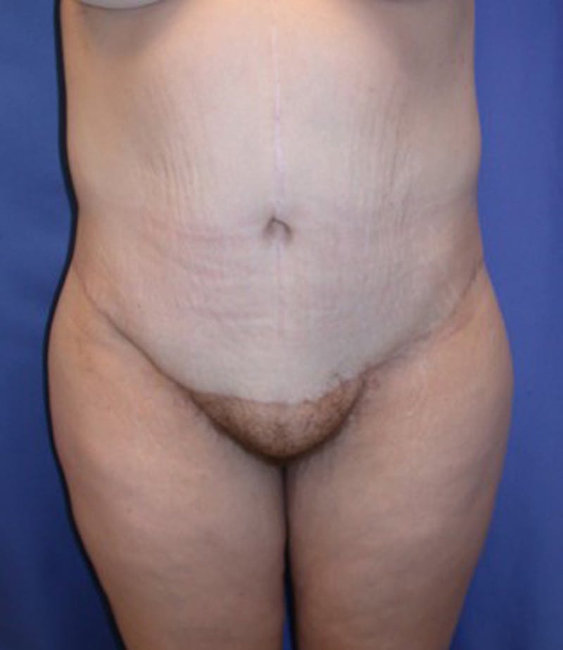 Massive Weight Loss Before & After Gallery - Patient 174163314 - Image 2