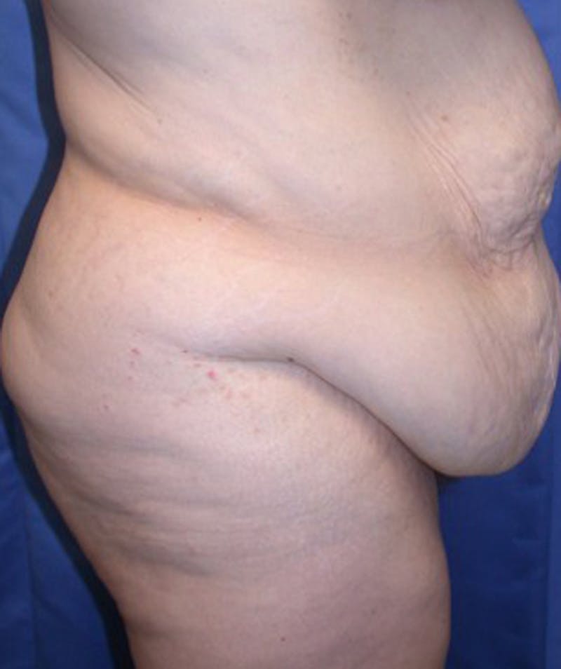 Massive Weight Loss Before & After Gallery - Patient 174163314 - Image 3