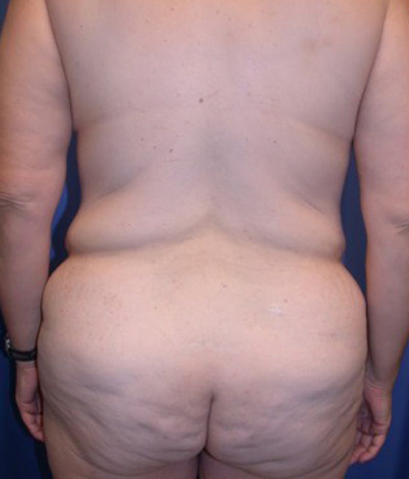 Massive Weight Loss Before & After Gallery - Patient 174163314 - Image 5