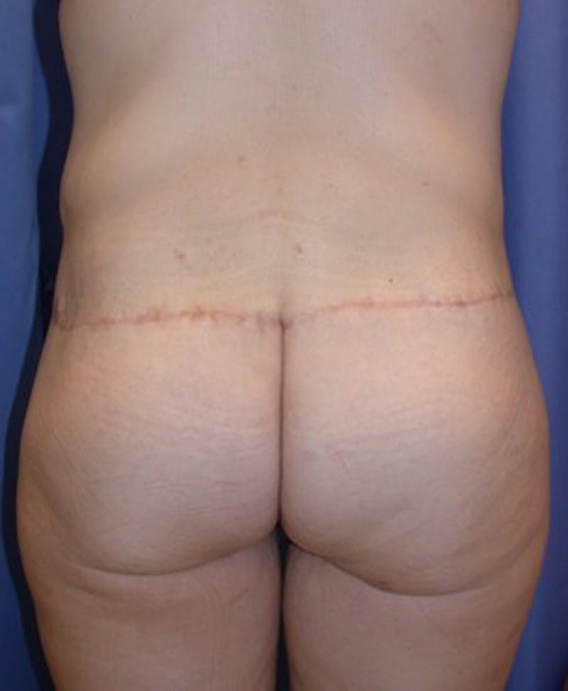 Massive Weight Loss Before & After Gallery - Patient 174163314 - Image 6