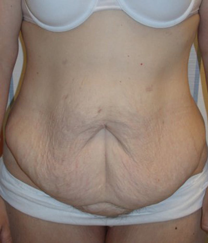Massive Weight Loss Before & After Gallery - Patient 174163322 - Image 1