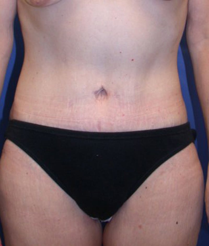 Massive Weight Loss Before & After Gallery - Patient 174163322 - Image 2
