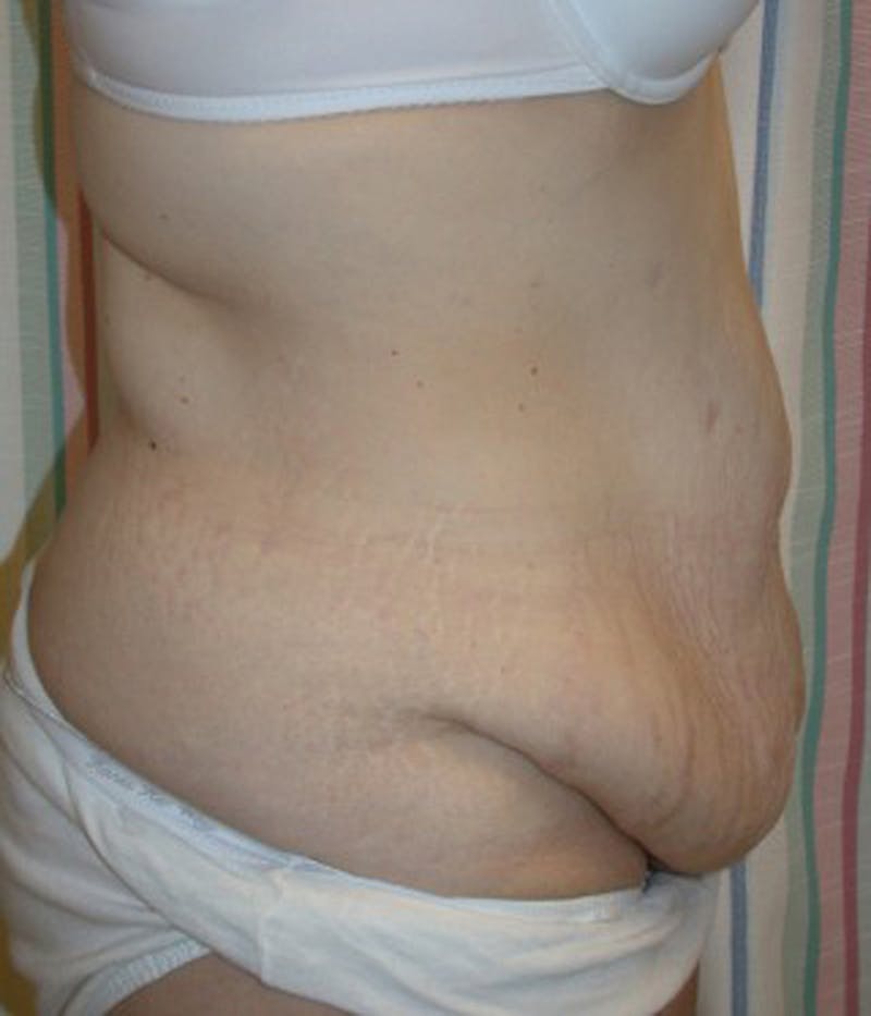 Massive Weight Loss Before & After Gallery - Patient 174163322 - Image 3