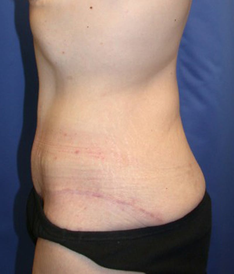 Massive Weight Loss Before & After Gallery - Patient 174163322 - Image 4