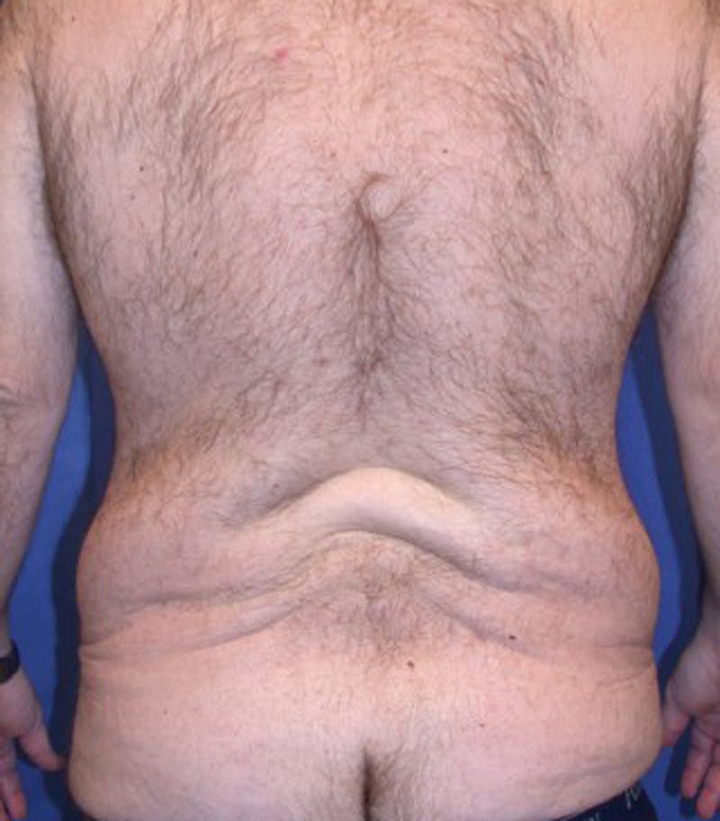 Massive Weight Loss Before & After Gallery - Patient 174164402 - Image 3