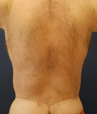 Massive Weight Loss Before & After Gallery - Patient 174164402 - Image 4