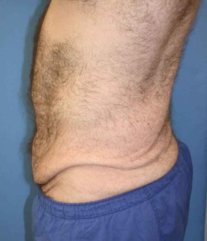 Massive Weight Loss Before & After Gallery - Patient 174164402 - Image 7