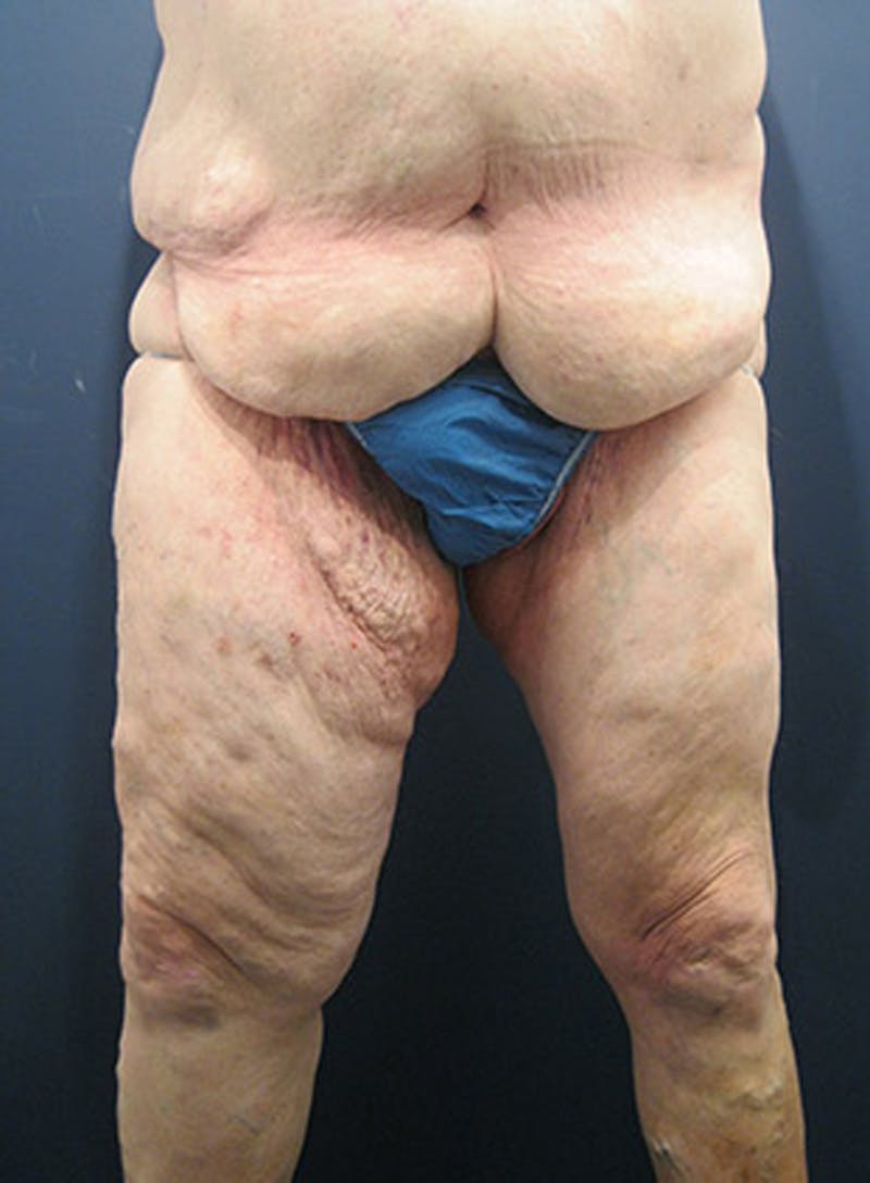 Massive Weight Loss Before & After Gallery - Patient 174164410 - Image 1