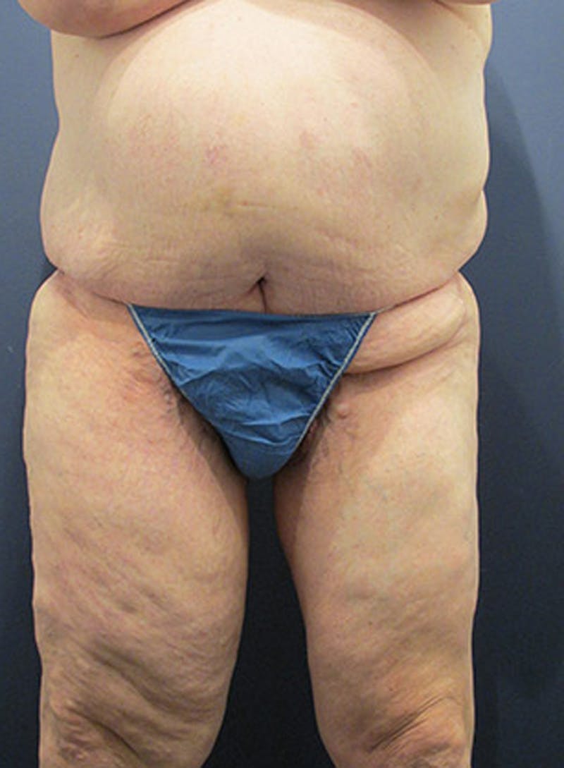 Massive Weight Loss Before & After Gallery - Patient 174164410 - Image 2