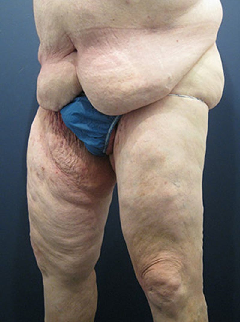 Massive Weight Loss Before & After Gallery - Patient 174164410 - Image 3