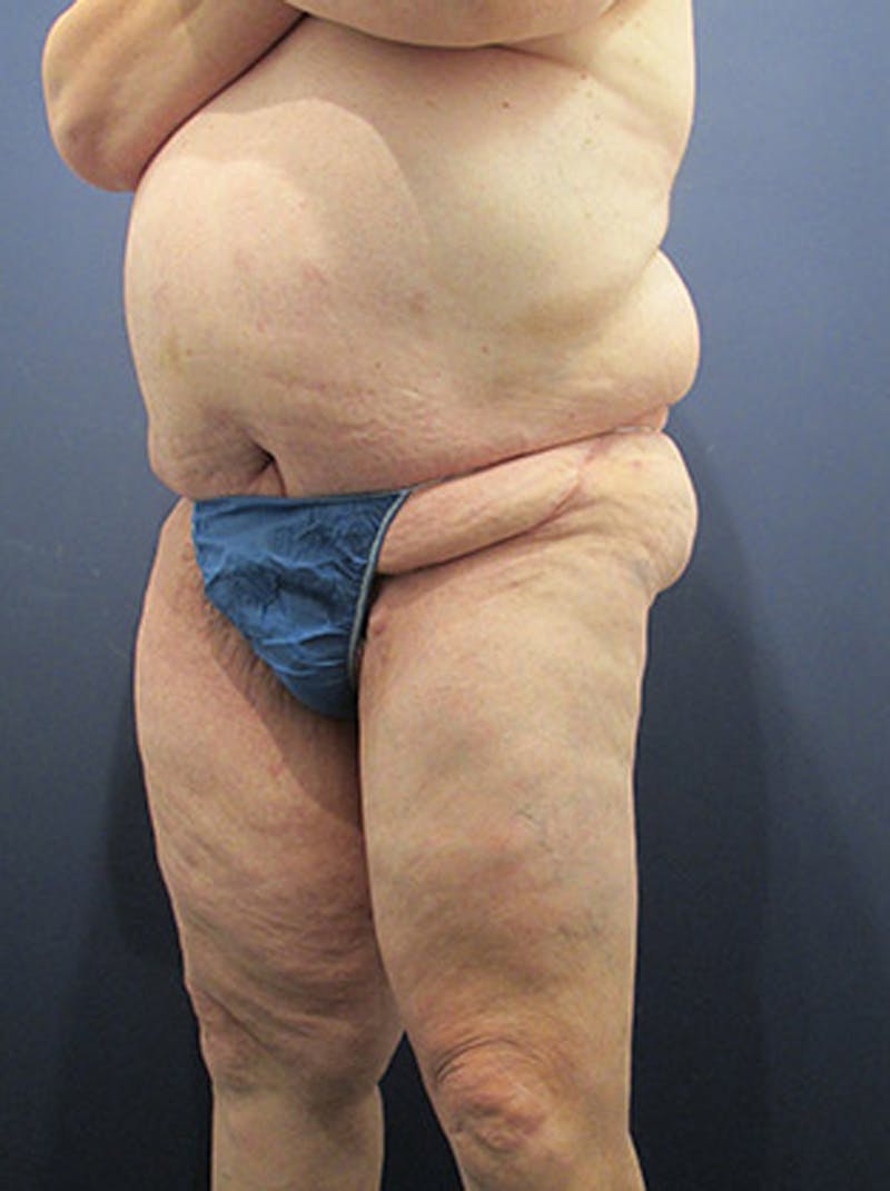 Massive Weight Loss Before & After Gallery - Patient 174164410 - Image 4