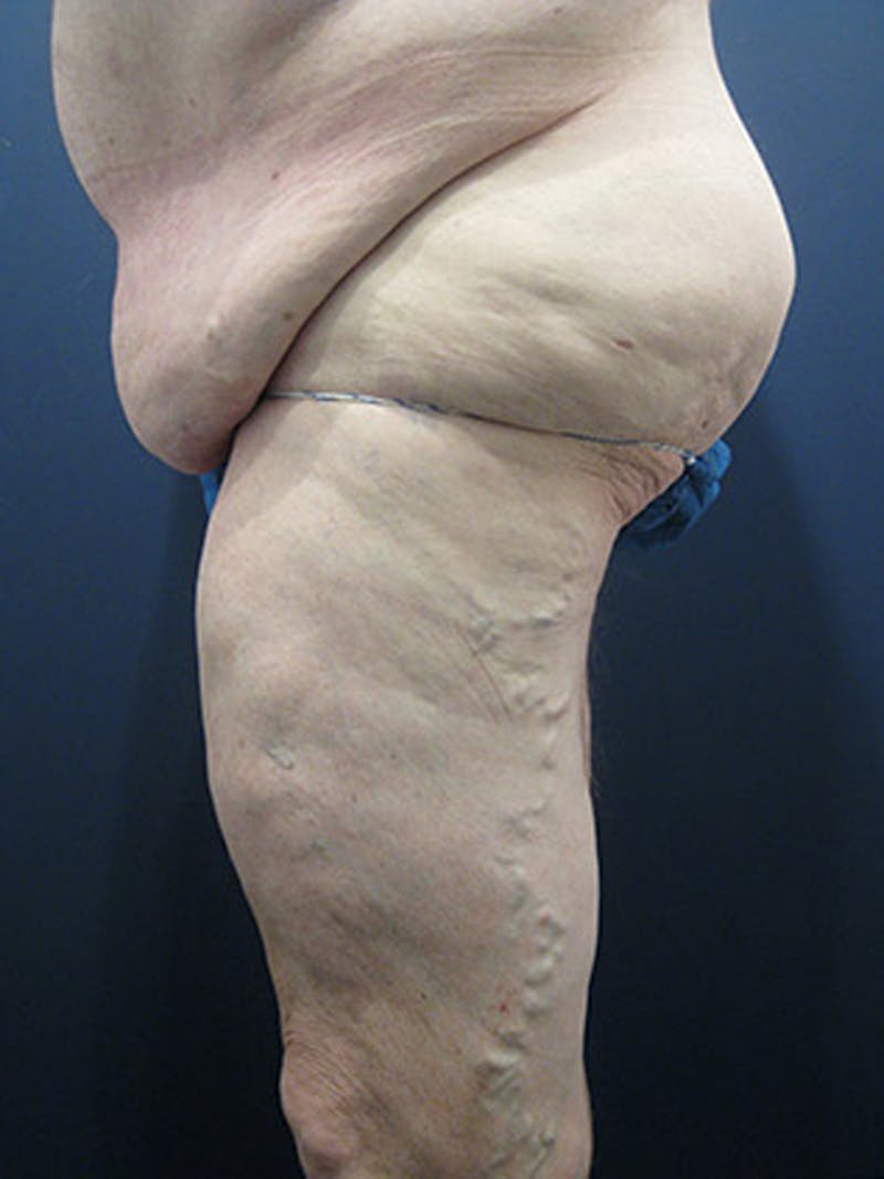 Massive Weight Loss Before & After Gallery - Patient 174164410 - Image 5