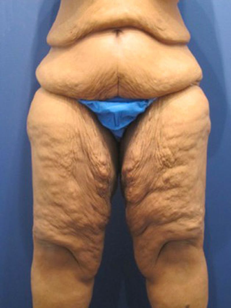 Massive Weight Loss Before & After Gallery - Patient 174164417 - Image 1