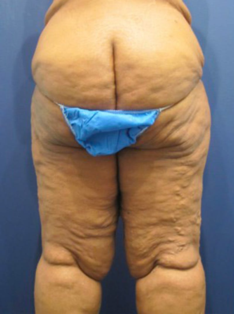 Massive Weight Loss Before & After Gallery - Patient 174164417 - Image 3