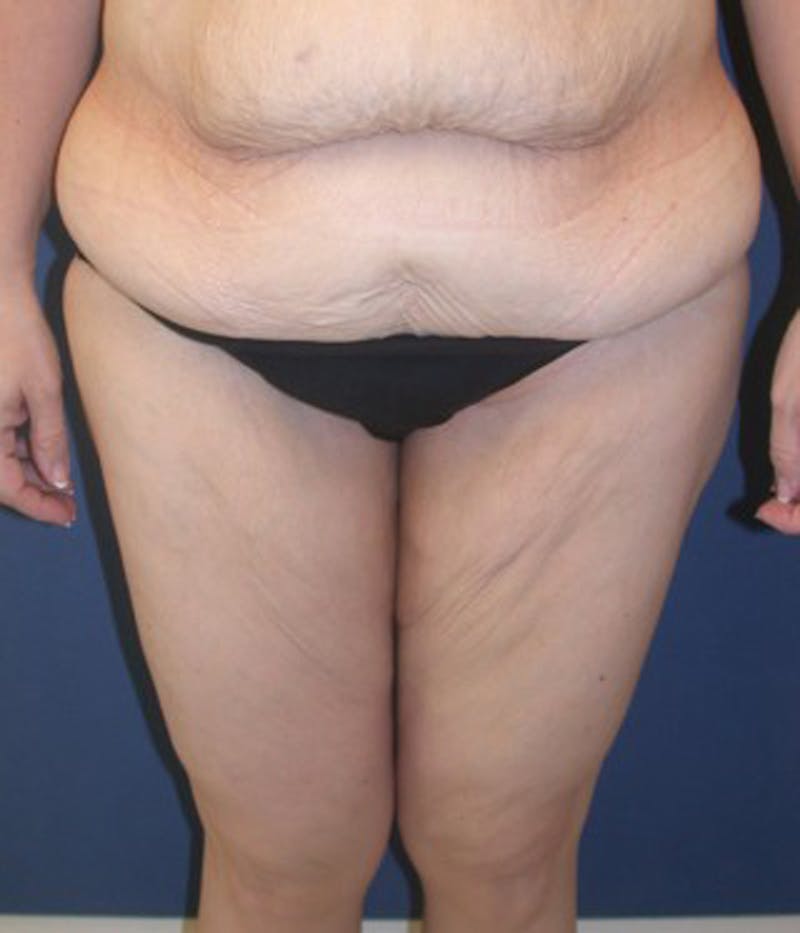 Massive Weight Loss Before & After Gallery - Patient 174164432 - Image 1