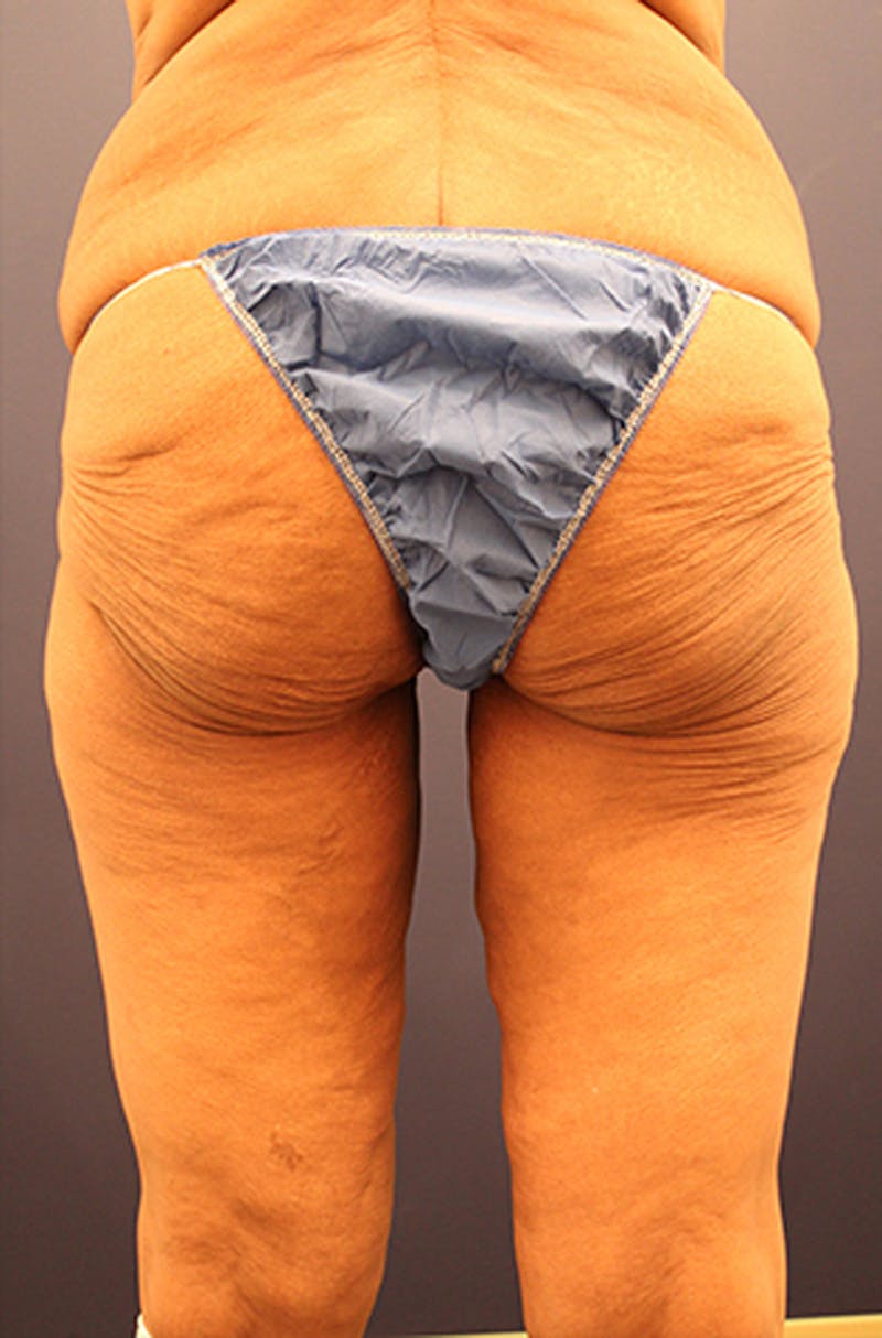 Massive Weight Loss Before & After Gallery - Patient 174164443 - Image 3