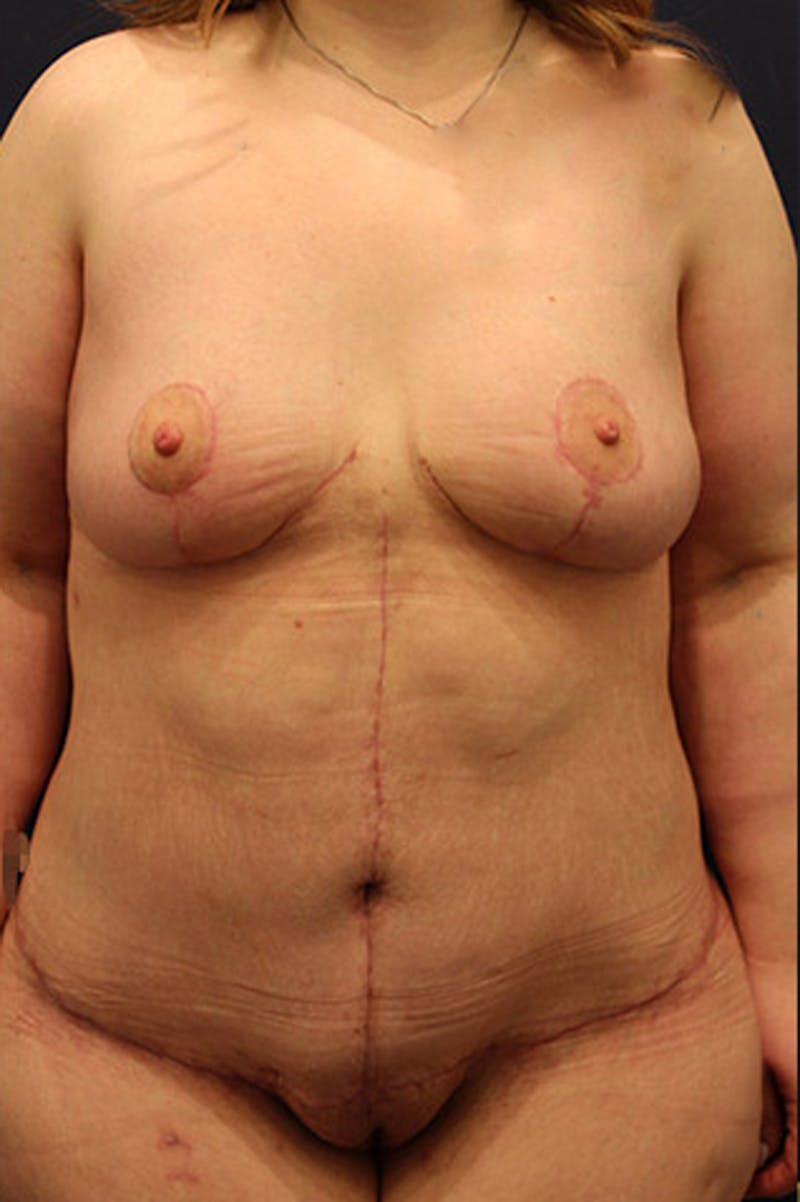 Massive Weight Loss Before & After Gallery - Patient 174164447 - Image 2