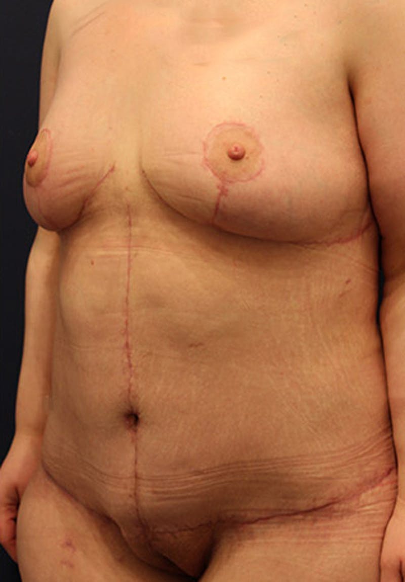 Massive Weight Loss Before & After Gallery - Patient 174164447 - Image 4