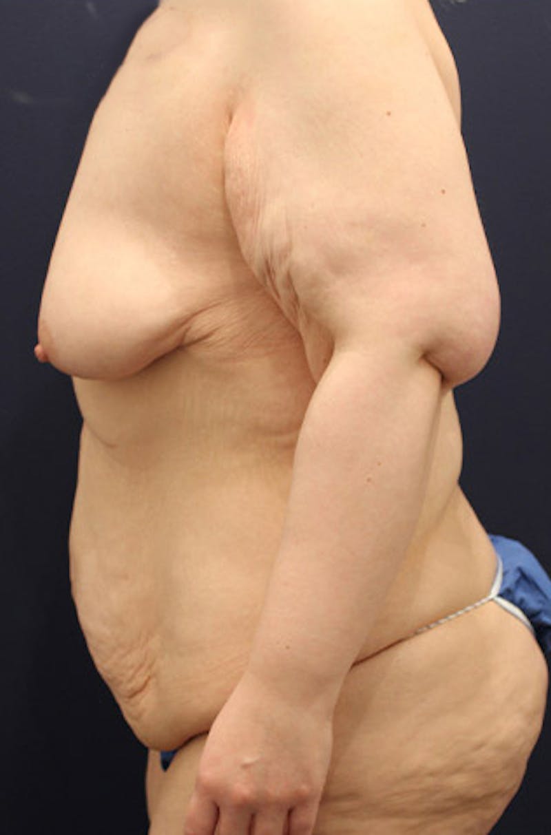 Massive Weight Loss Before & After Gallery - Patient 174164447 - Image 5