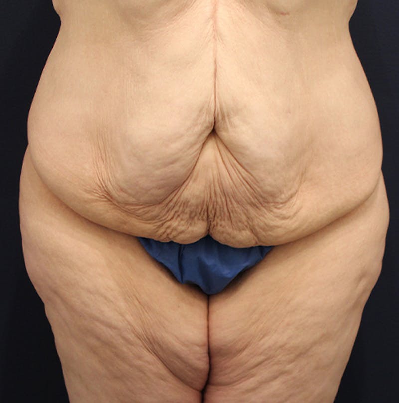 Massive Weight Loss Before & After Gallery - Patient 174164454 - Image 1