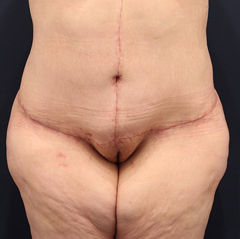 Massive Weight Loss Before & After Gallery - Patient 174164454 - Image 2