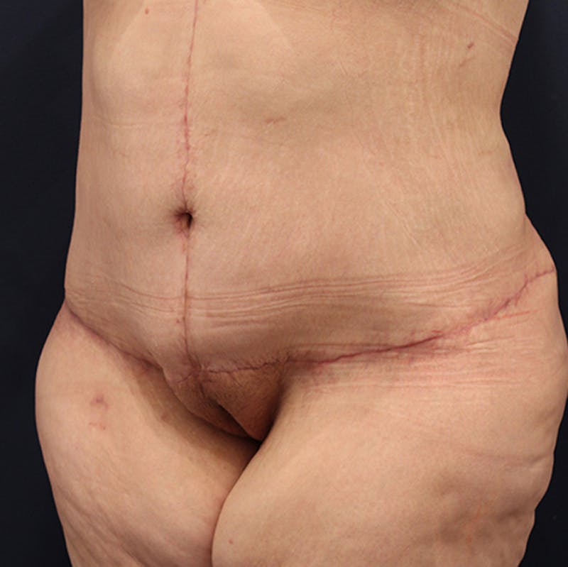 Massive Weight Loss Before & After Gallery - Patient 174164454 - Image 4