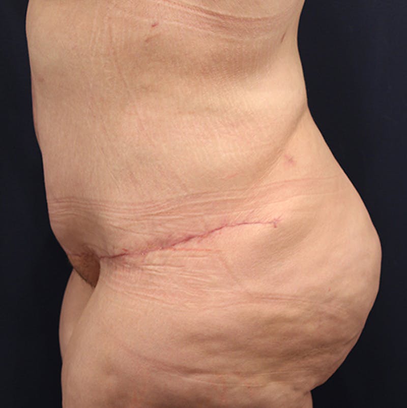 Massive Weight Loss Before & After Gallery - Patient 174164454 - Image 6