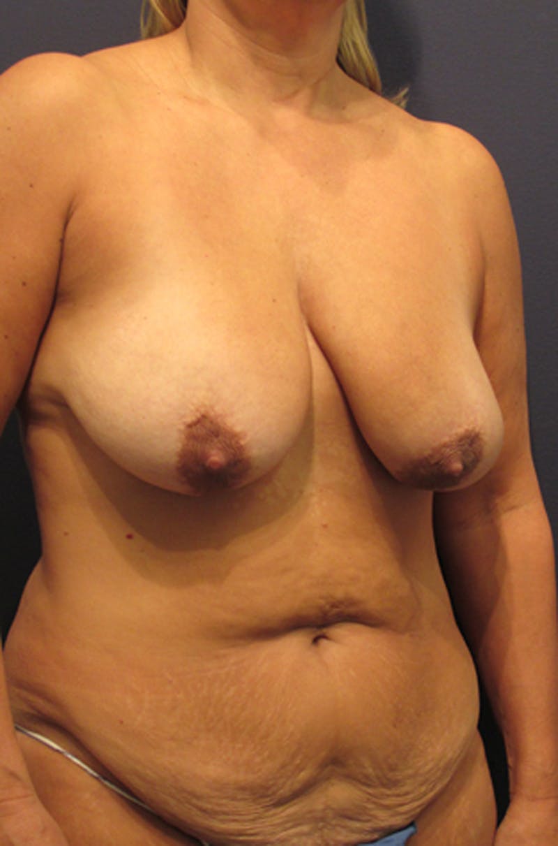 Mommy Makeover Before & After Gallery - Patient 174163229 - Image 3