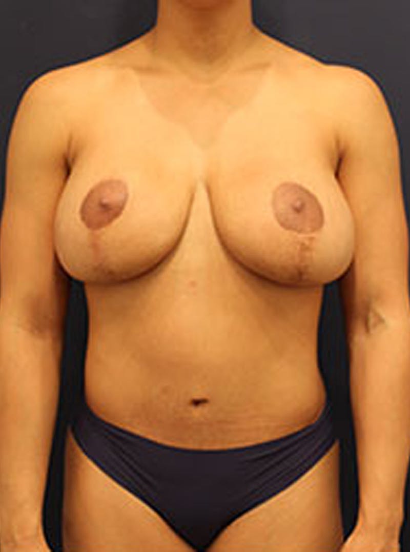 Mommy Makeover Before & After Gallery - Patient 174163256 - Image 2