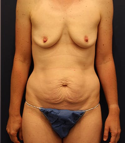 Mommy Makeover Before & After Gallery - Patient 174163262 - Image 1