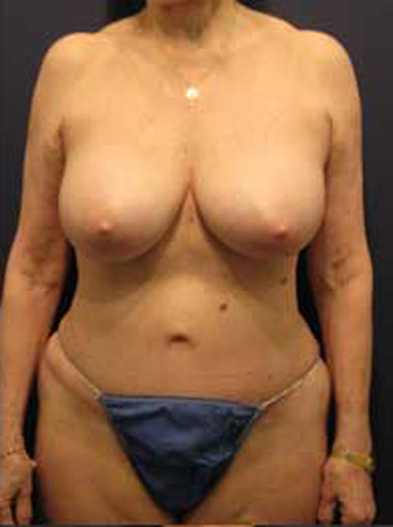 Mommy Makeover Before & After Gallery - Patient 174163281 - Image 2