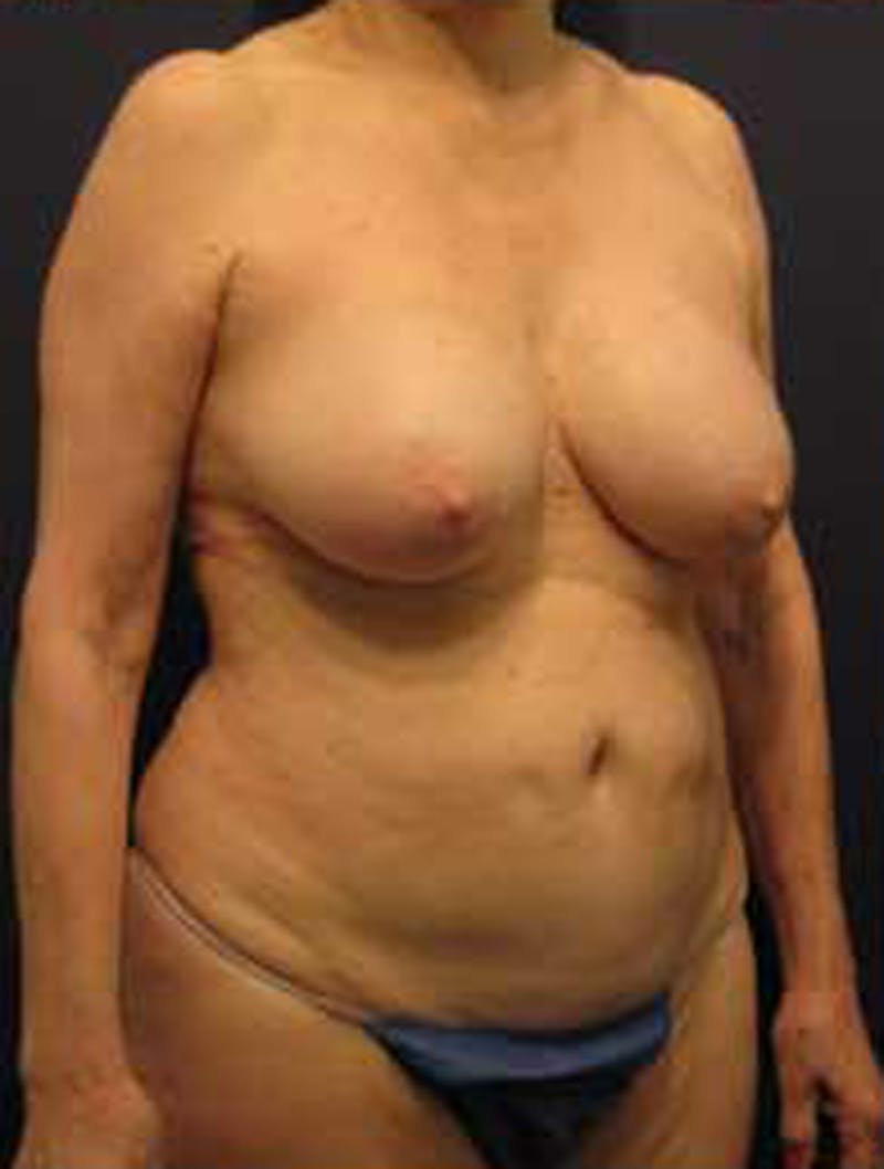 Mommy Makeover Before & After Gallery - Patient 174163281 - Image 3