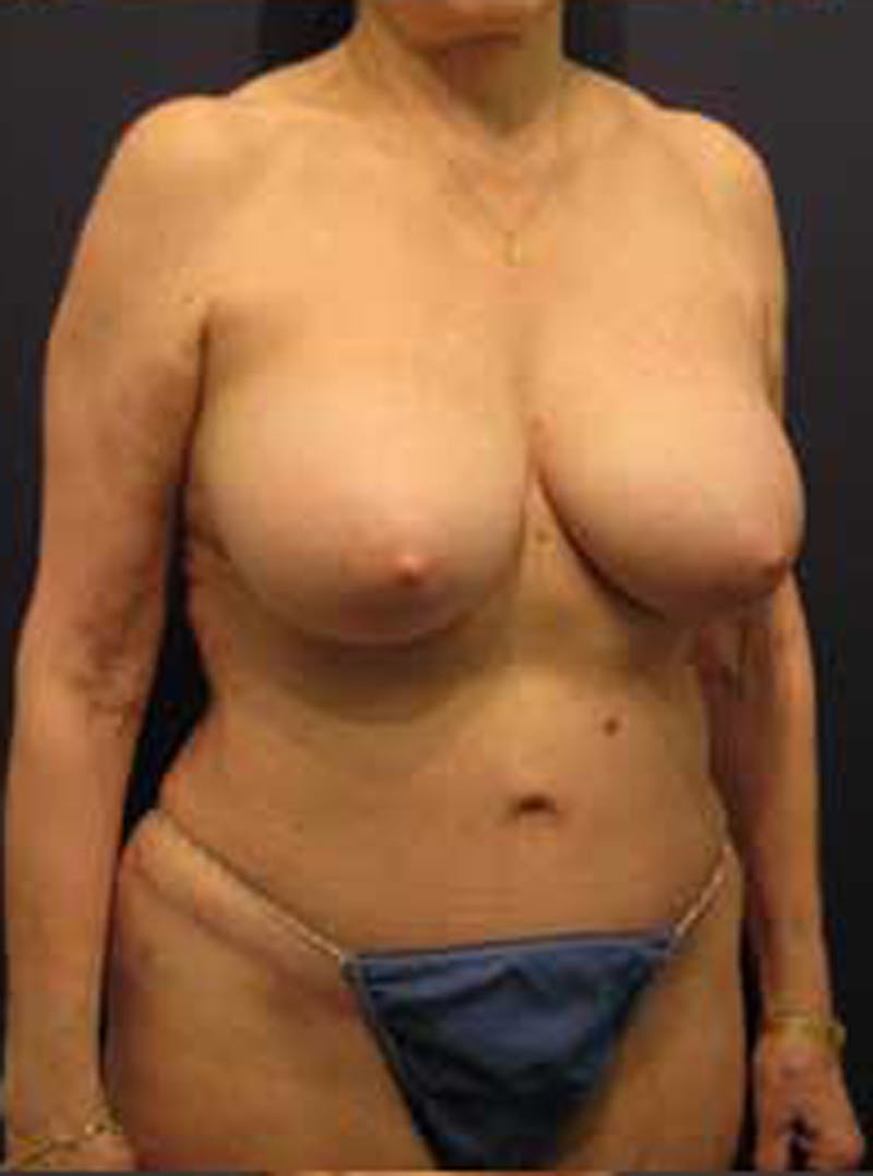 Mommy Makeover Before & After Gallery - Patient 174163281 - Image 4