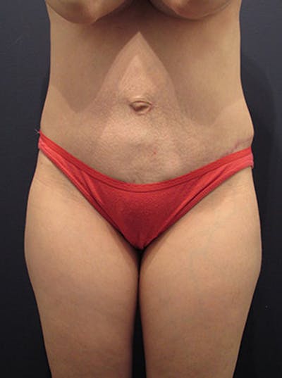 Mommy Makeover Before & After Gallery - Patient 174163288 - Image 2