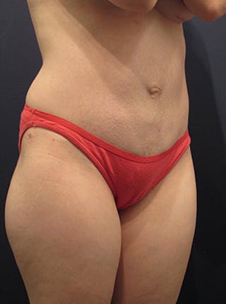 Mommy Makeover Before & After Gallery - Patient 174163288 - Image 4