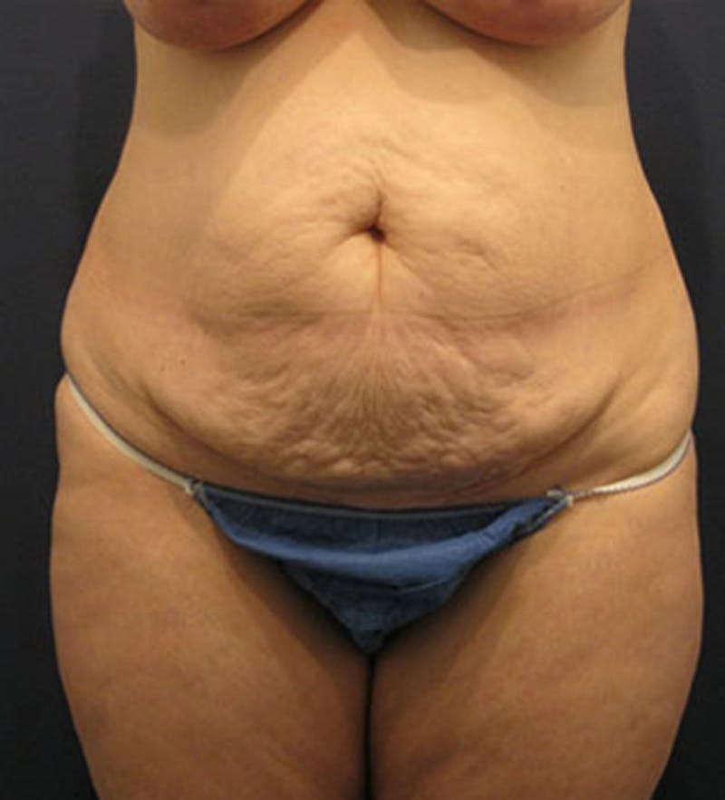 Mommy Makeover Before & After Gallery - Patient 174163303 - Image 1